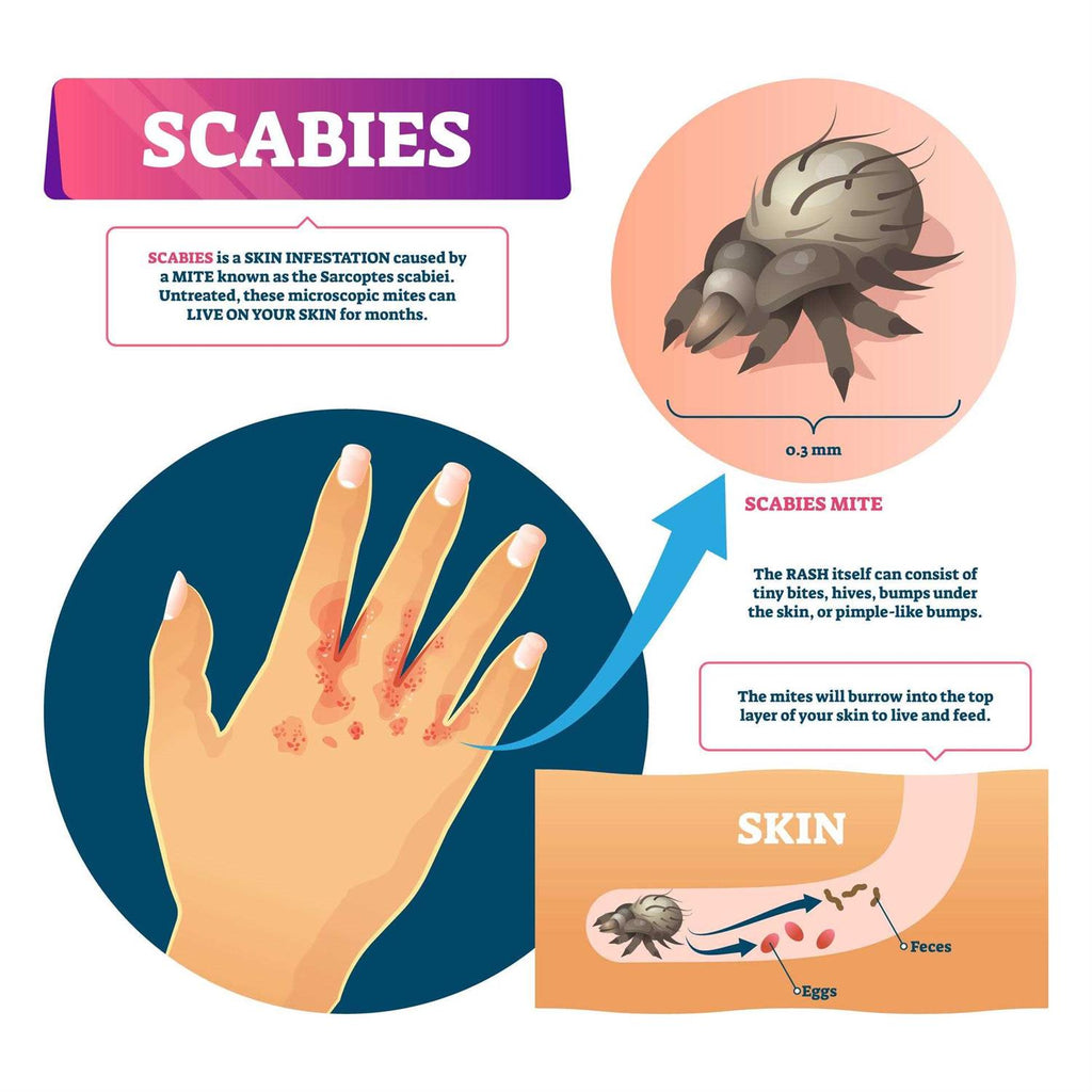 Scabies Cream X474054